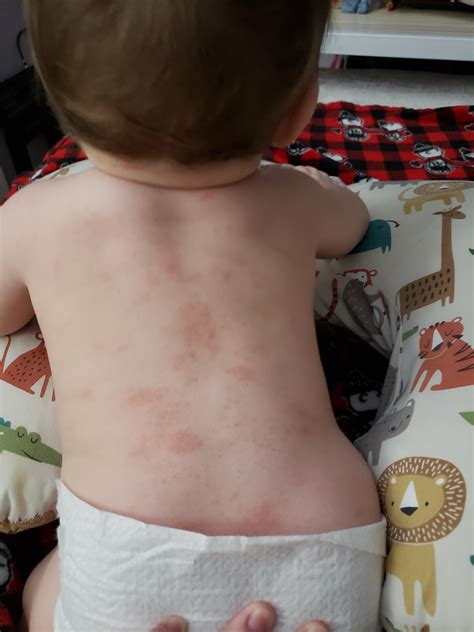 Heat Rash On Back