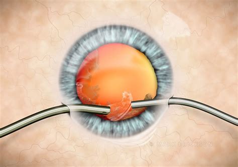cortex aspiration  bimanual phaco  cataract surgery