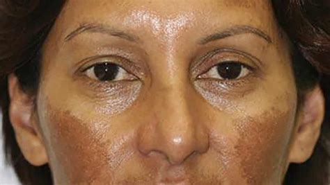 What is Melasma and can it be treated? | Collins Cosmetic Clinic
