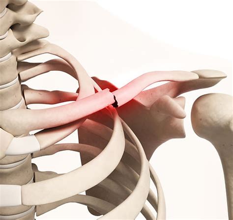 clavicle fractures | Queenstown Joint Clinic