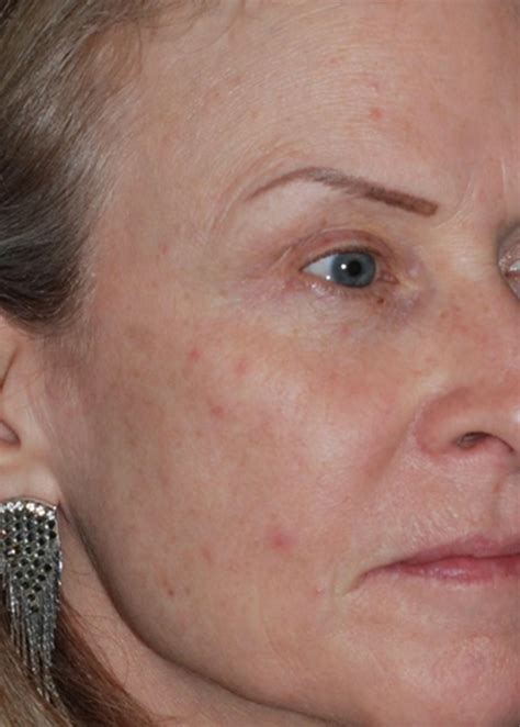 Before & After Malar Bags / Festoons in Atlanta, GA | Oculus