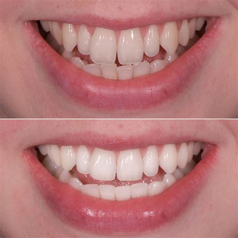 Tooth Contouring: How Cosmetic Teeth Reshaping Works And The After
