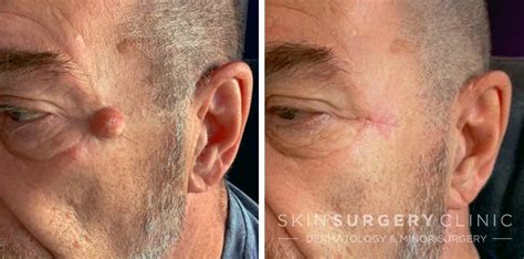 cyst removal  newcastle   skin surgery clinic