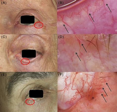 Eyelid margin BCC (EMBCC): clinical presentation as small erythematous ...
