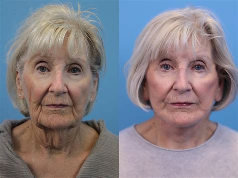 facelift    pictures case  west des moines ames