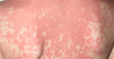 The Foster Home: Allergic Reaction