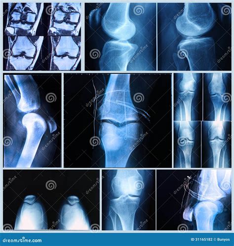 Knee Medical Exam: X-ray and MRI Scan Stock Photo - Image of anatomy