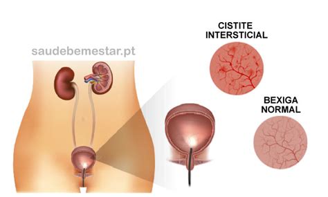 Como Fica A Bexiga Com Cistite - Cistite intersticial - o que é, causas, sintomas, tratamento, cura