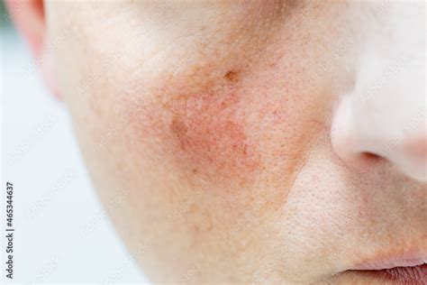 Red face, broken blood vessels, health problems Stock Photo | Adobe Stock