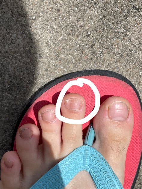 vertical line in toenail 2