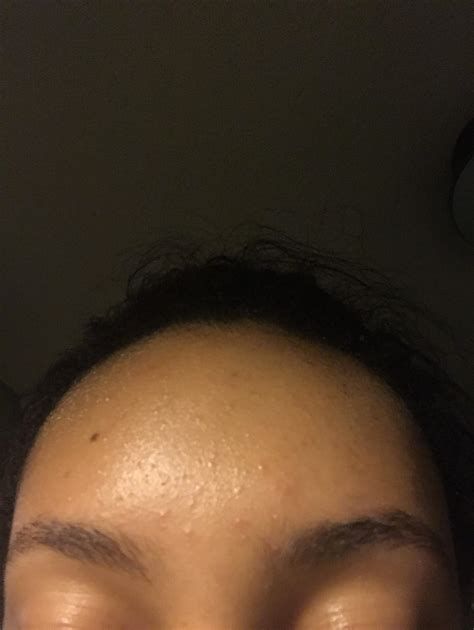 how to remove bumps from forehead 2