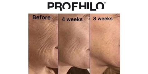 PROFHILO