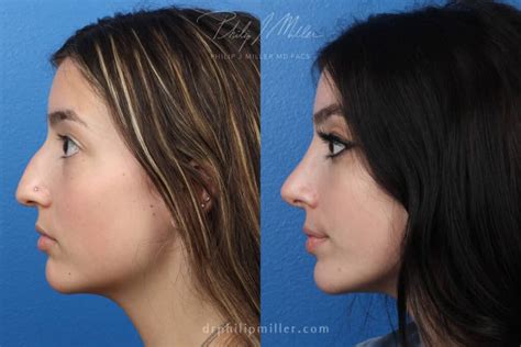choose  nose tip surgery  full rhinoplasty philip miller md