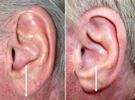 Earlobe Reduction Richmond VA | Reduce Earlobe | Earlobe Surgery