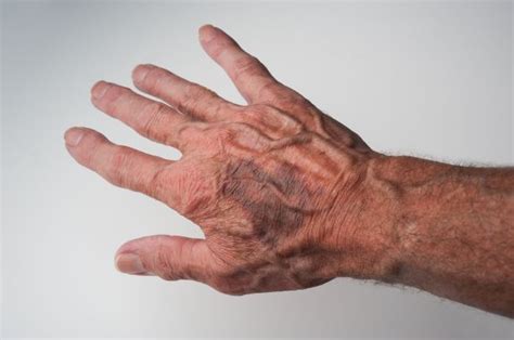 Understanding elderly skin bruising – Artofit