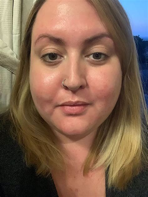 'Cruel strangers called my skin disgusting before I found miracle cream