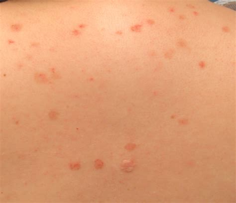 Pemphigus Foliaceus | School of Medicine