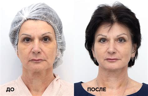 Нити Аптос (Aptos) для подтяжки лица - цена нитевого лифтинга в Санкт ...