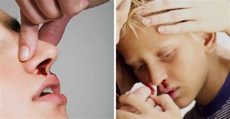Coágulos De Sangue Saindo Do Nariz E Boca