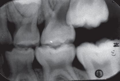 Ectopic eruption of maxillary first permanent molar | Pocket Dentistry