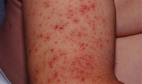 tinea barbae definition  symptoms diagnosis treatment