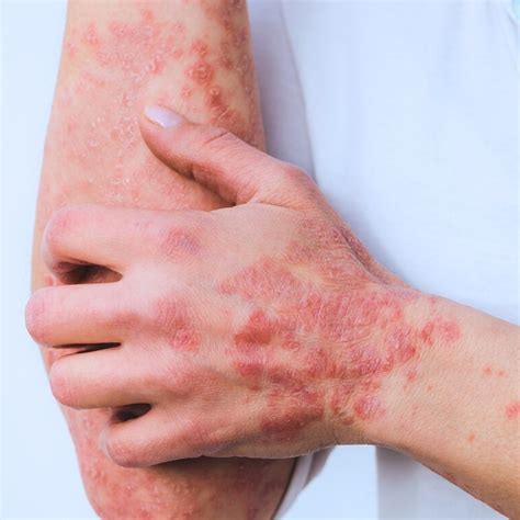 Psoriasis Treatment London - Derma Revive Skin Clinic