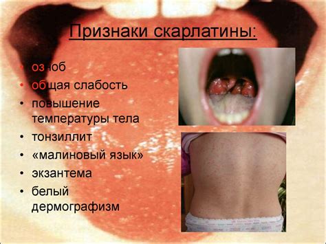 Скарлатина - презентация онлайн