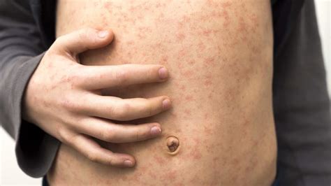 campak  salah satu penyakit menular   mudah menular