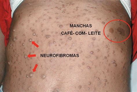 Manchas Cafe Com Leite Na Virilha - Neurofibromatose Tipo 1 Manchas Cafe Com Leite Entenda As Principais