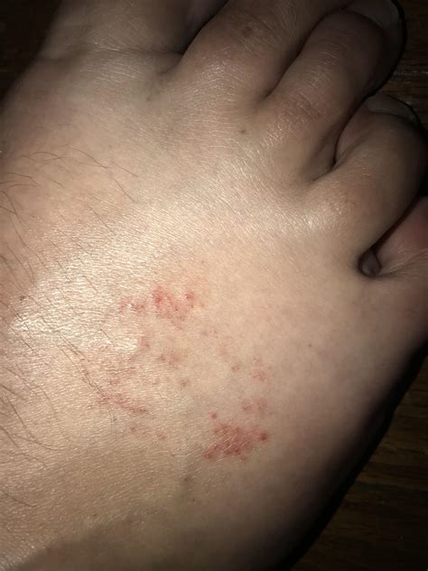 Foot Skin Rash On Top Of Foot Store | emergencydentistry.com