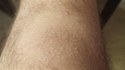 Tiny white bumps appeared on my knees out of no where. Got a really