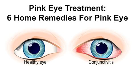 how to fix pink eye
