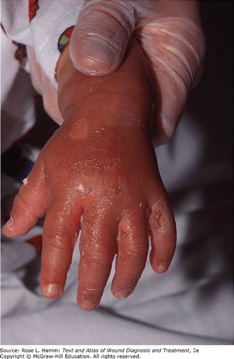 burn wound management musculoskeletal key