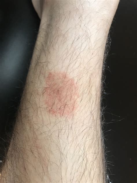 Baby Rashes On Legs