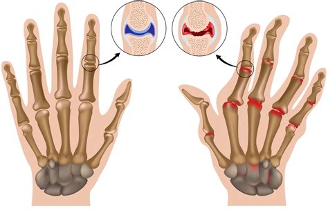 Early Osteoarthritis Hands