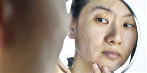 Acne Holes On Face Causes, Types, Treatment, Cost and Prevention Tips