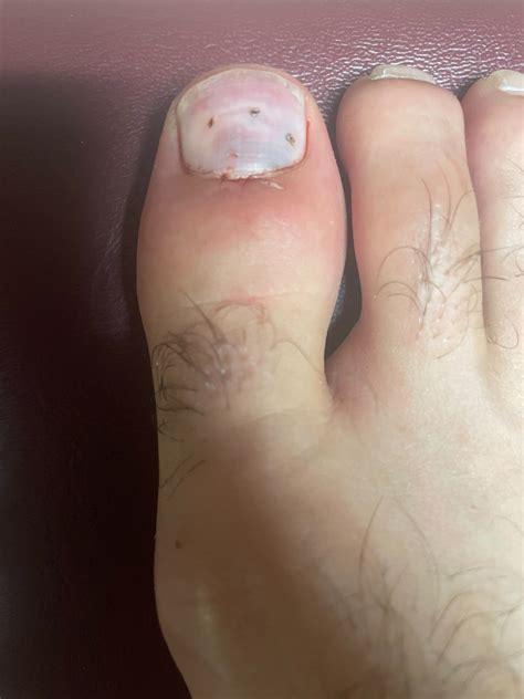 The Medical Term Subungual Means Pertaining To The Nail