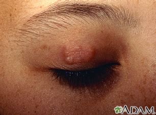 granuloma annulare uf health