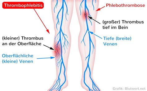 Thrombophlebitis - Ursachen und Symptome