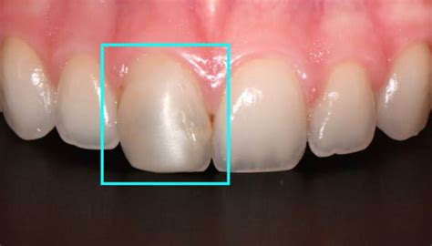 Cavity Filling Before And After
