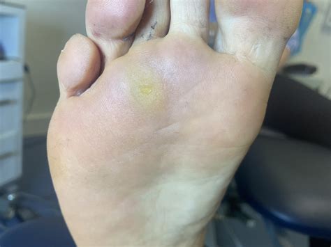 Corns | What we treat | Manchester Podiatry | Leading podiatry provider