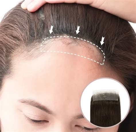What Are Hair Patches For Bald Spots And Where To Buy? - Hair System