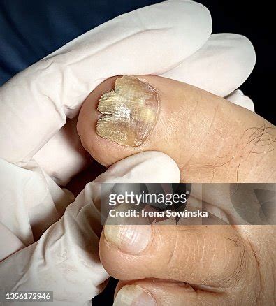 Onicomicosi High-Res Stock Photo - Getty Images