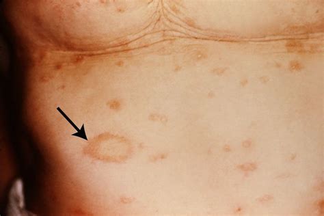 imagepityriasis rosea herald patch merck manual consumer version
