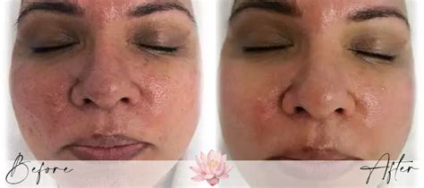 Aquafirme XS - Dr. Diego Wellness & Aesthetics