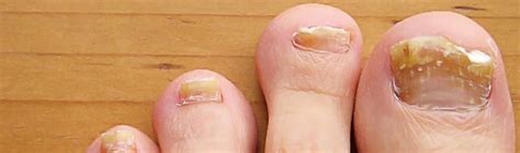 Tratamento de micoses de unha com laser - Especialista- Lasers ...
