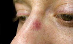 how to fix broken capillaries on nose