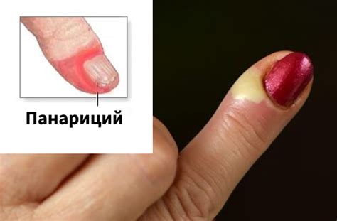 Панариций на пальце руки — лечение: мази, антибиотики