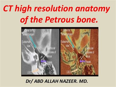 Presentation1.pptx, ct high resolution anatomy of the petrous bone.