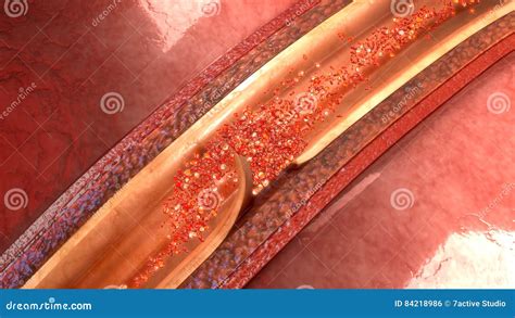 Artery Dissection Stock Photo | CartoonDealer.com #84218208